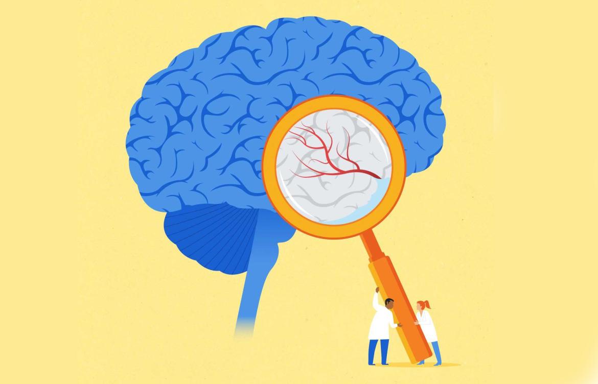 Illustration of a blue brain with doctors using an oversized magnifying glass