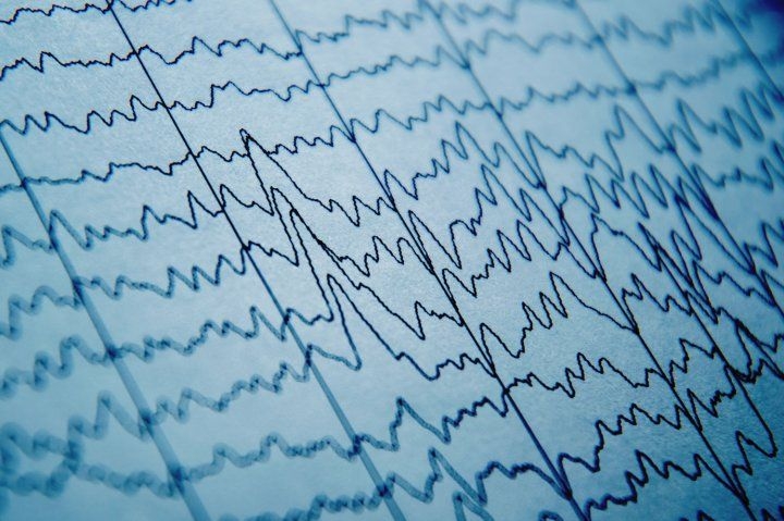 Brain wave activity on an EEG