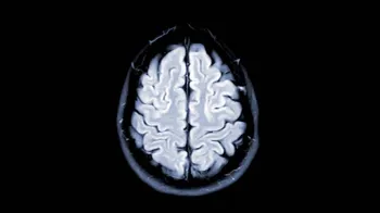 photo of brain MRI