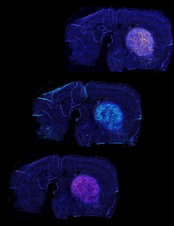 T-cells attacking a glioblastoma