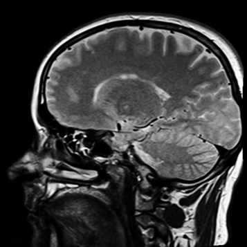 MRI image of a human head