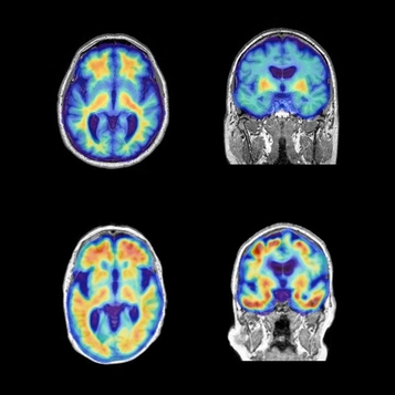 PET scans