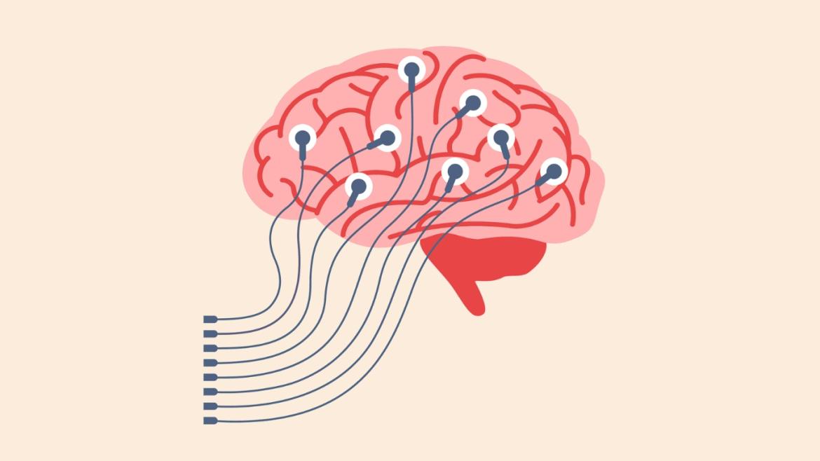Illustration of a brain with electrodes attached to it
