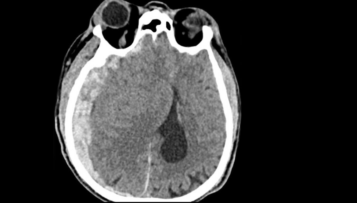 CT imaging of a patient over age 65 with a traumatic brain injury