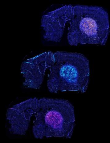 T-cells attacking a glioblastoma