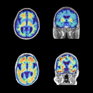 PET scans