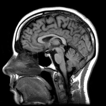 MRI of the human brain