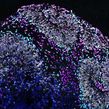 Microscope image of a brain organoid derived from human stem cells that contain a mutation associated with autism spectrum disorder.